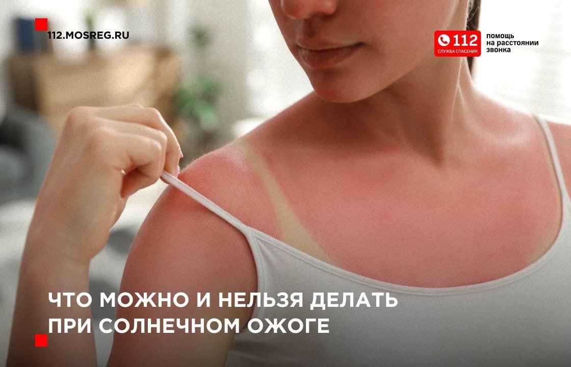 Что делать, если вы переусердствовали с загаром