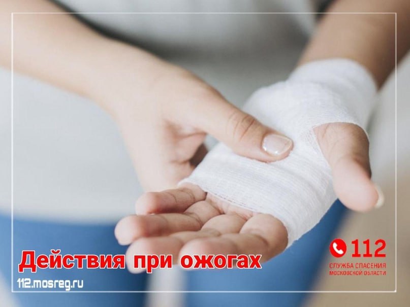 Действия при ожогах